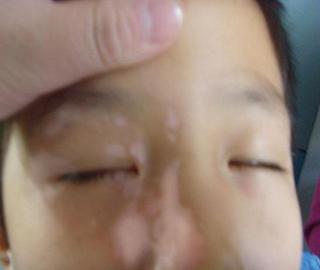 哪些因素導致兒童患上白癜風疾病?