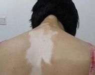 網(wǎng)易白癜風(fēng)的病因一般都有哪些