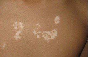 身上一直長白斑是什么原因?