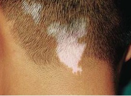 什么樣的環(huán)境因素會導致白癜風高發(fā)?