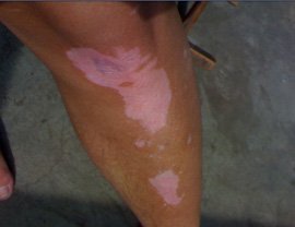 腿部外傷能引起白癜風嗎?