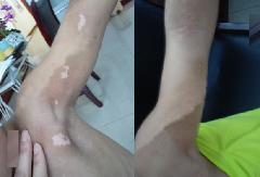 白癜風患者日常飲食需要注意哪些?