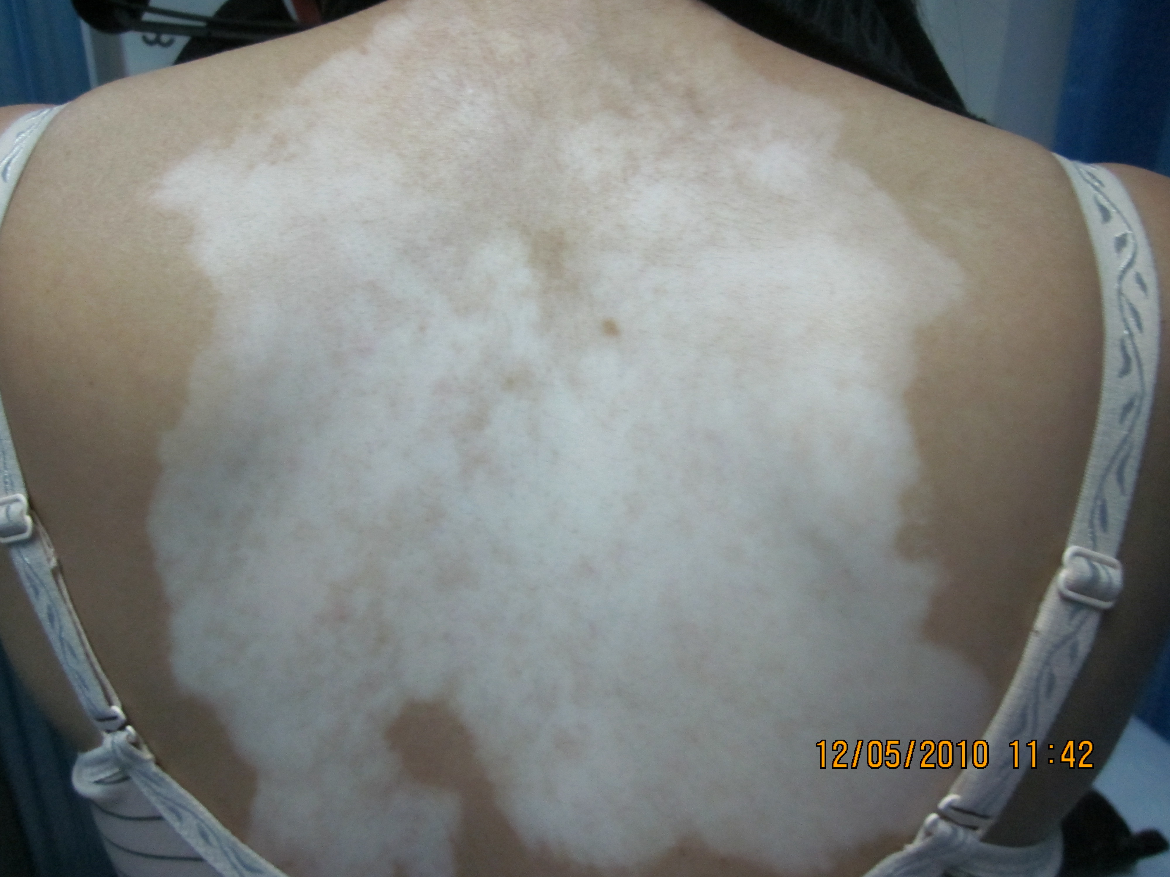 什么因素容易引起白癜風病情加重?