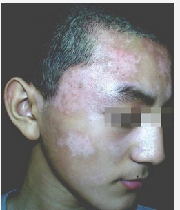 男性穩定期白癜風秋季擴散是什么原因