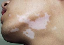 陽光暴曬是誘發(fā)白癜風的原因嗎