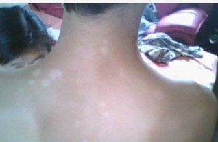 會引起白癜風的因素有哪些