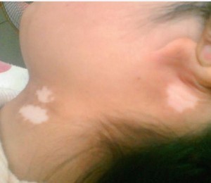 頸部白癜風的發病病因有哪些