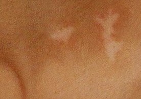 誘發白癜風發病的因素有哪些方面