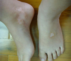 腳部白癜風(fēng)反復(fù)復(fù)發(fā)的原因有哪些