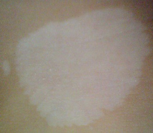 春季白癜風的發病原因