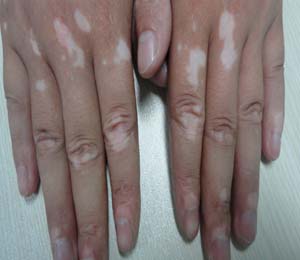 手上出現(xiàn)白癜風(fēng)會是什么原因