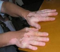 手部容易出現(xiàn)白癜風(fēng)的原因