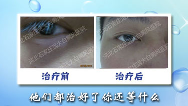 導(dǎo)致白癜風(fēng)的常見原因都是什么