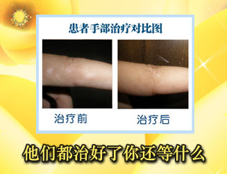 外傷是怎樣引起白癜風(fēng)病發(fā)的