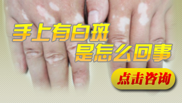 手部白癜風發癢一般都是啥原因