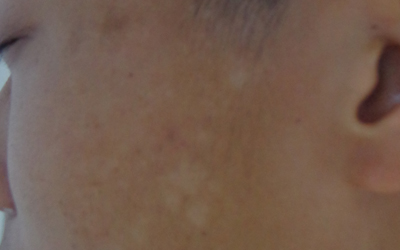 臉上長白斑原因