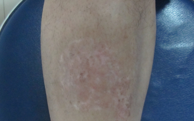 膝蓋處磕破了以后長白斑