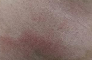 容易被忽視的白癜風病因