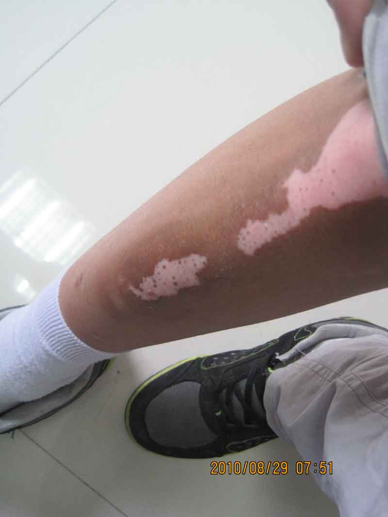 腿部白癜風(fēng)的癥狀有哪些