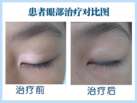 眼睛下長白斑 是白癜風嗎