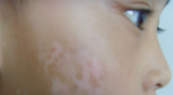 臉上長白斑的原因與白癜風的基本常識