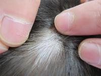 石家莊白癜風(fēng)醫(yī)院：頭上白癜風(fēng)如何治療好?