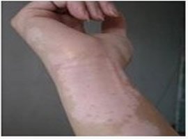 手臂上有米粒大的白點是怎么回事?