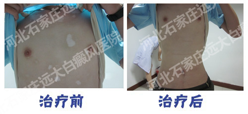 <a href=http://www.xvxgx.cn/ target=_blank class=infotextkey>石家莊白癜風醫院</a>白癜風會不會出現在胸部