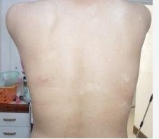 背部的白癜風應怎樣治療