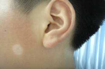 面部白癜風(fēng)治療注意的事項有哪些