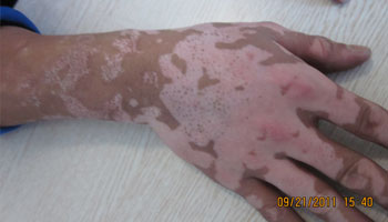 手臂上出現的白點是怎么回事