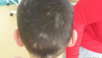 怎樣預防頭部白癜風擴散