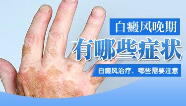 手部出現白癜風會有哪些特點