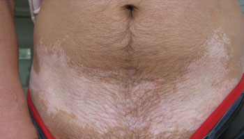 腰部有不均勻的白斑是不是白癜風(fēng)