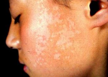 臉上出現(xiàn)小白點是不是早期白癜風(fēng)