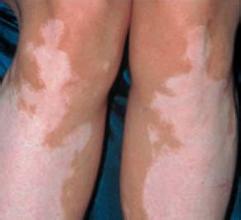 腿上出現了些白點是白癜風嗎