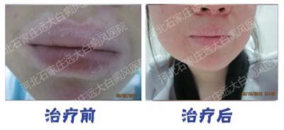  面部白癜風治療有哪些注意事項