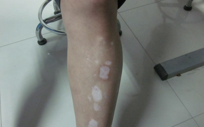 右邊小腿上有三四塊白斑可以照光嗎