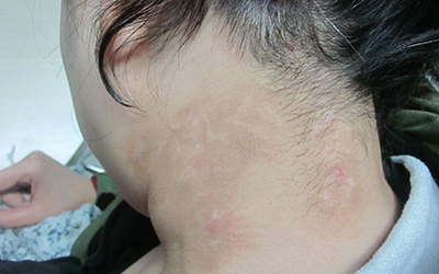 頸部長白斑三個月怎么治療好一些