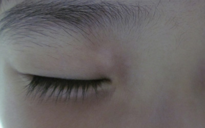 眼皮白一片還越來越大該怎么辦