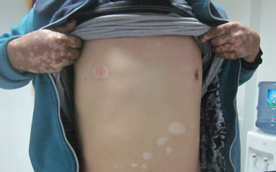 肚子上和胸部有幾塊白癜風怎么治