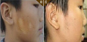 滄州醫院治療白癜風一般多久能好