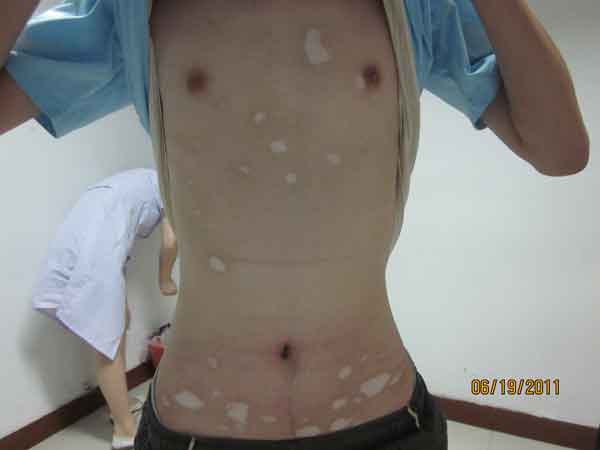 白癜風,白癜風復發