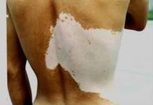 <a href=http://www.xvxgx.cn/ target=_blank class=infotextkey>石家莊白癜風醫院</a>白癜風擴散速度快嗎?