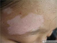 治療白癜風的民間偏方都有什么?