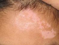 如何護(hù)理能降低白癜風(fēng)的復(fù)發(fā)幾率?