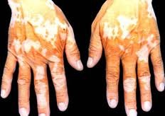 哪些因素容易引起白癜風的同形反應?