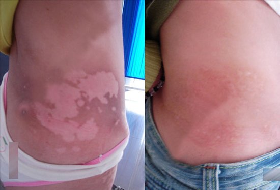 白斑用308激光照射后恢復正常了還會復發(fā)么?