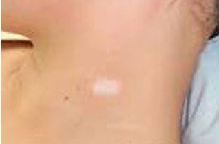 白癜風不治會不會擴散