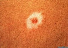 暈痣性白癜風要治好需要多長時間?